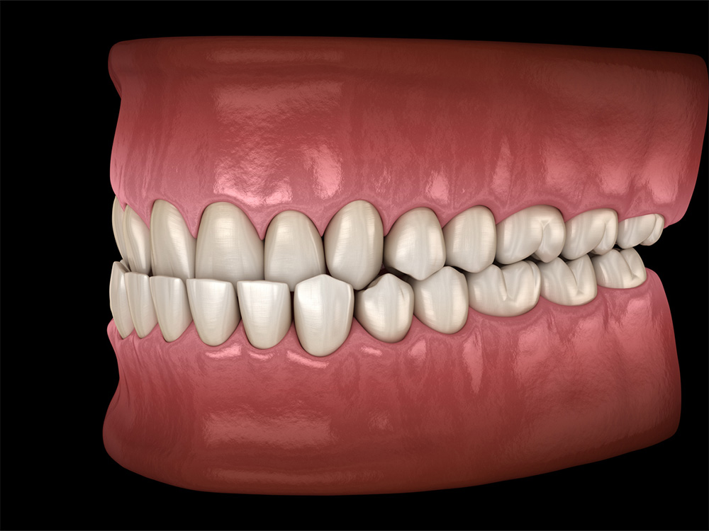 3D illustration of a human lower jaw with an underbite, showing the lower teeth extending beyond the upper teeth, highlighting the dental misalignment against a dark background.