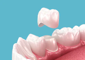 Same-day dental crowns at Rooted Dentistry in Black Diamond, WA