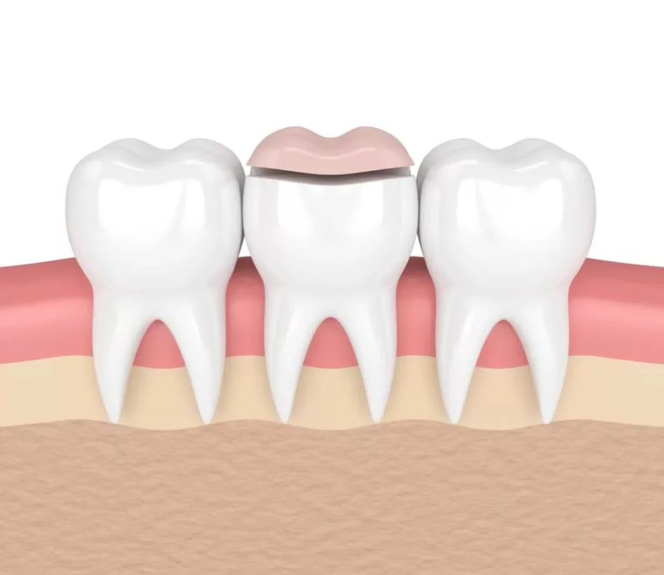 Dental Inlays and Dental Onlays available at Rooted Dentistry in Black Diamond, WA