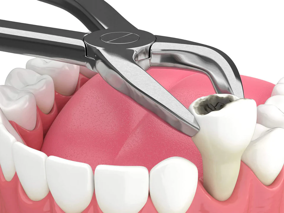 Tooth Extractions available at Rooted Dentistry in Black Diamond, WA