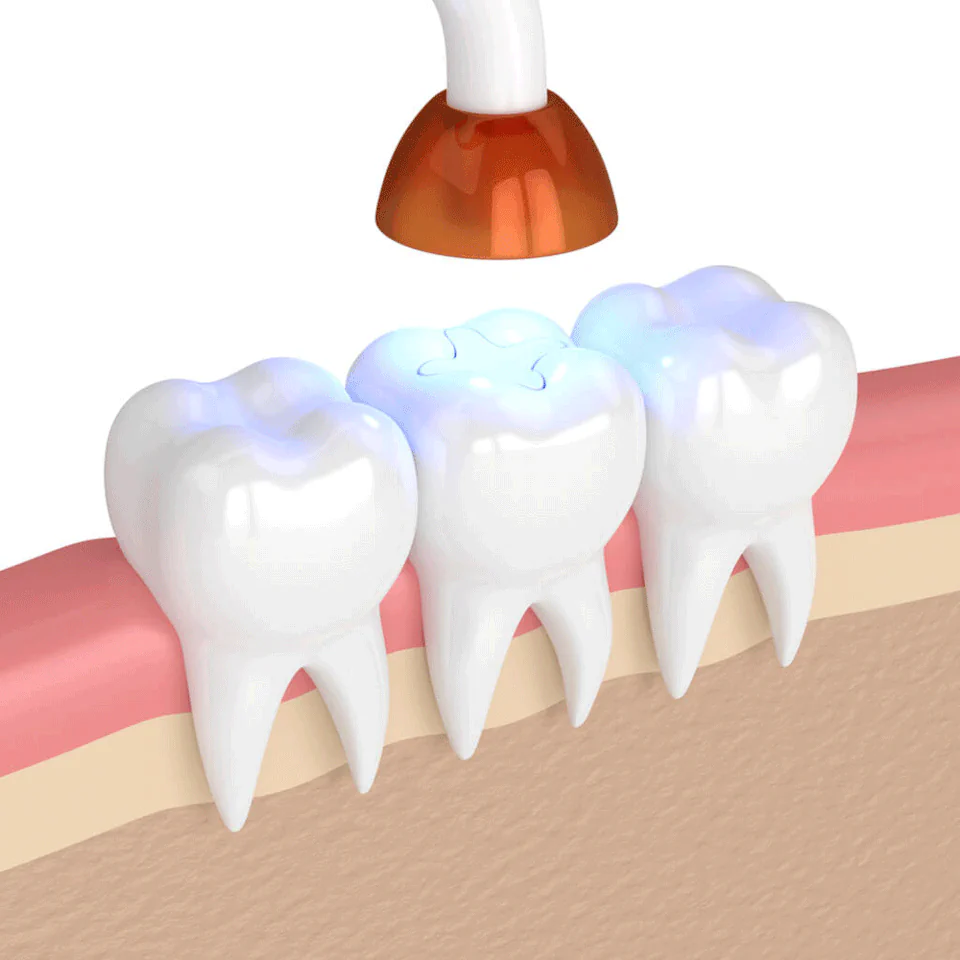 Tooth fillings and dental sealants available at Rooted Dentistry in Black Diamond, WA